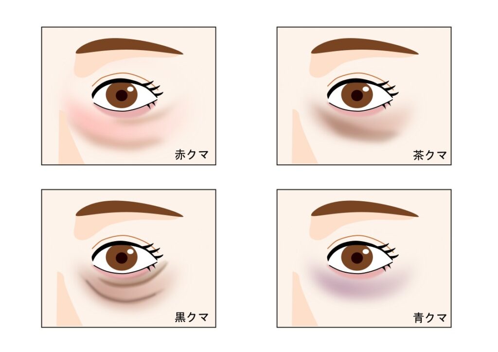 「クマには種類がある！まずは自分のクマタイプをチェックしよう