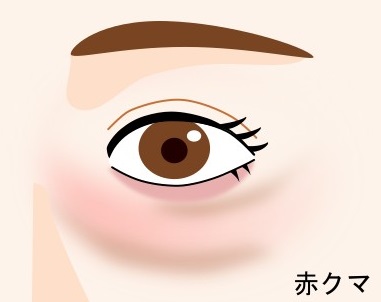 【赤クマ】血行不良と炎症が原因！目元を冷やしてケアしよう